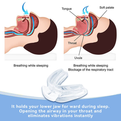 Anti-Snoring Bruxism Mouth Guard – Sleep Aid for Snore & Apnea Relief